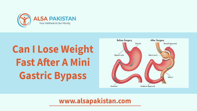 Can I Lose Weight Fast After A Mini Gastric Bypass?