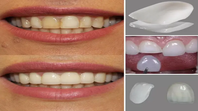 How Long Do Porcelain Veneers Last? A Comprehensive Guide by Top NYC Dentists