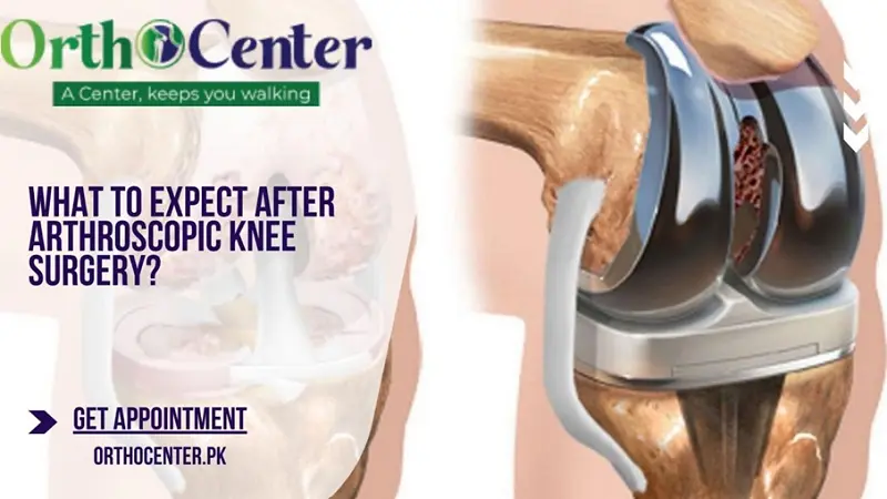 What To Expect After Arthroscopic Knee Surgery?